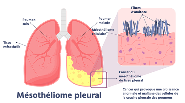L'amiante source de cancer